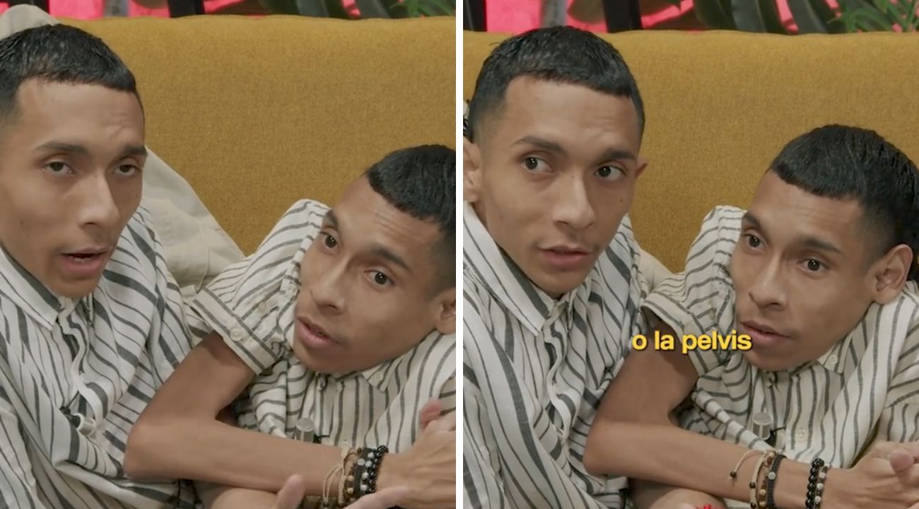 gemelli siamesi vita quotidiana