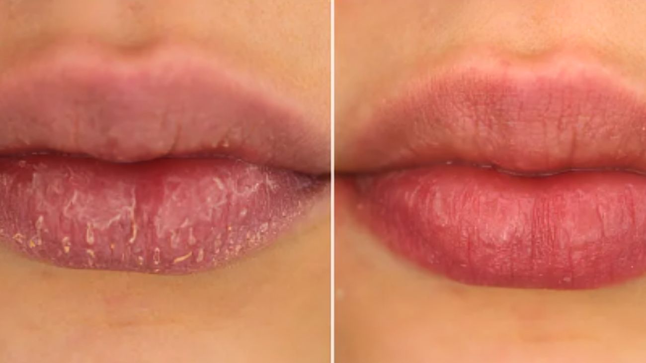 Labbra screpolate, ecco come rimediare. Fonte social